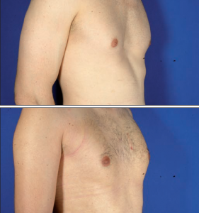 Pectus Excavatum antes y despues