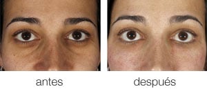 El nitrógeno líquido en la cosmetología para la persona las revocaciones