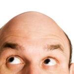 Alopecia microinjerto