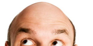Alopecia microinjerto