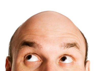 Alopecia microinjerto