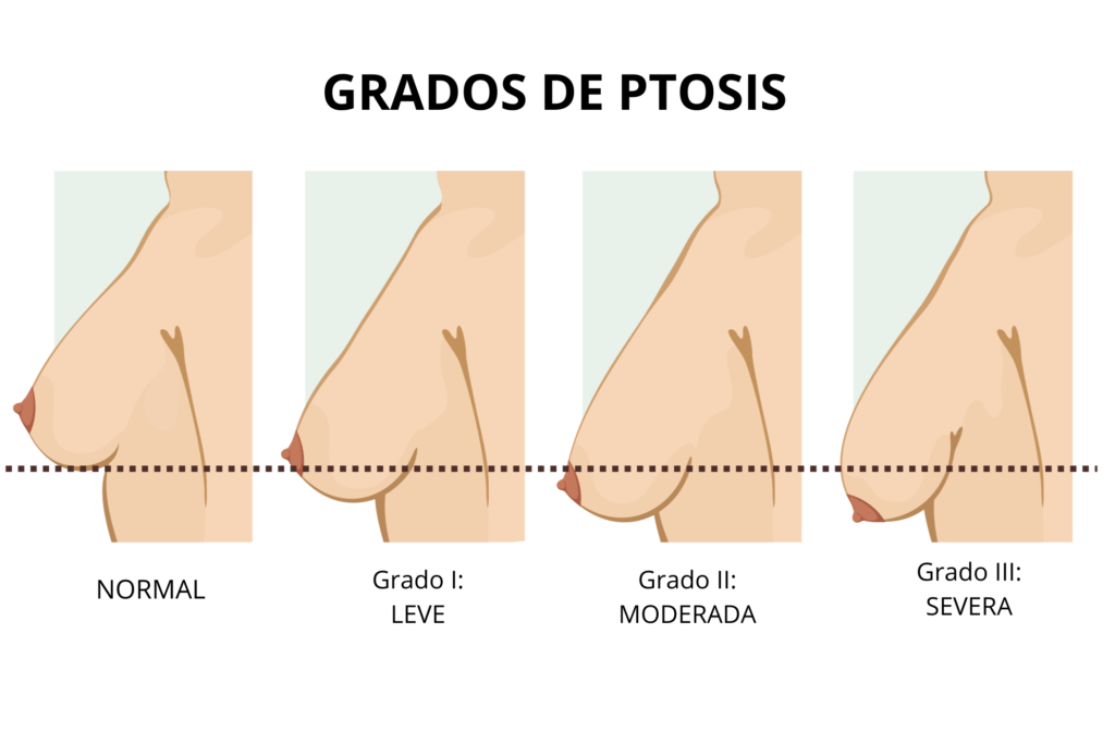 grados ptosis mamaria