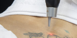 Eliminación de tatuajes