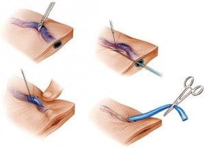 MIcrocirugía reconstructiva