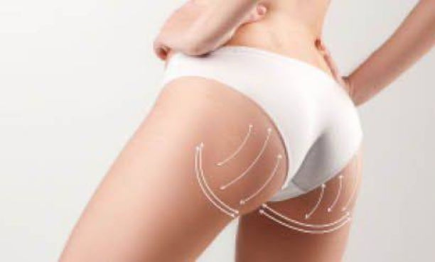 aumento de glúteos lipofilling