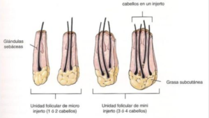 Unidad folicular alopecia