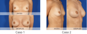 variación aumento de mamas