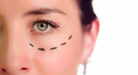 blefaroplastia cirugía de los parpados