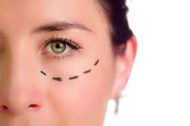 blefaroplastia cirugía de los parpados