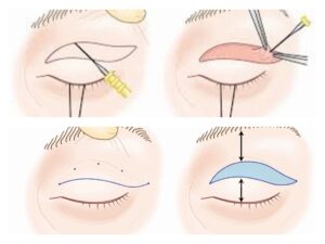 cirugia de parpados blefaroplastia