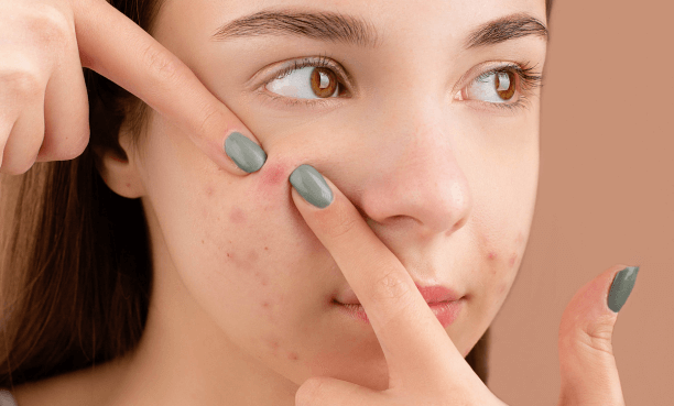 cicatrices acne