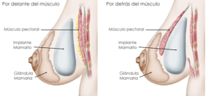 cirugia de aumento de mama