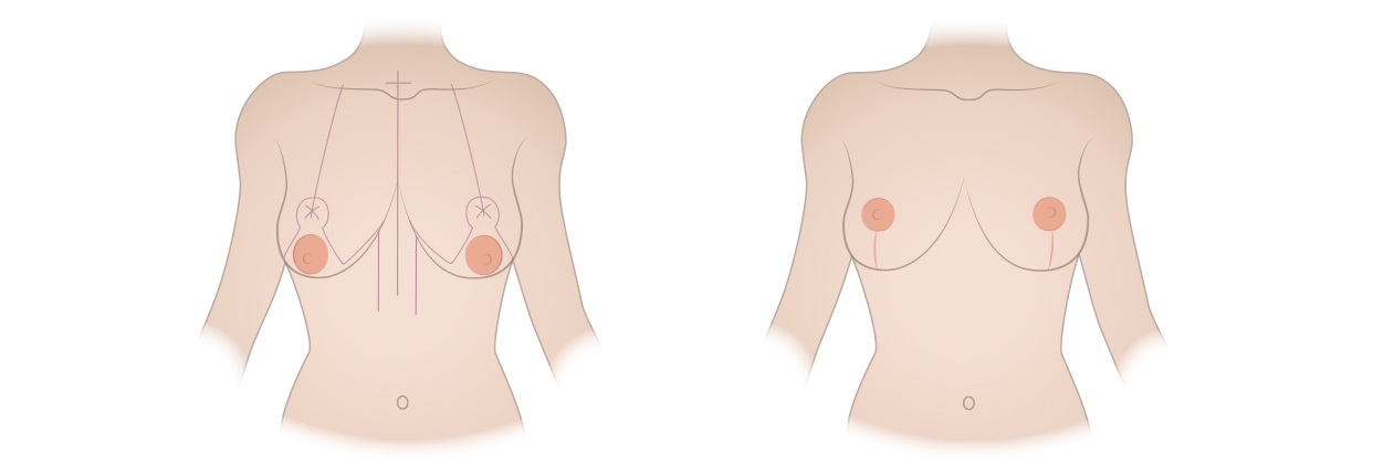 Elevación y reducción de senos