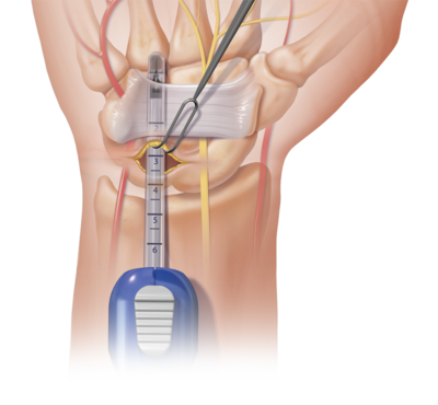 tecnica endoscopica tunel carpiano