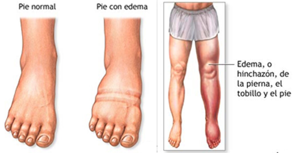 linfedema linfologia