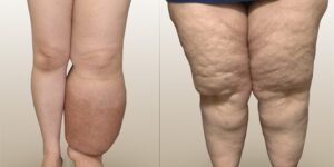 lipedema y linfedema