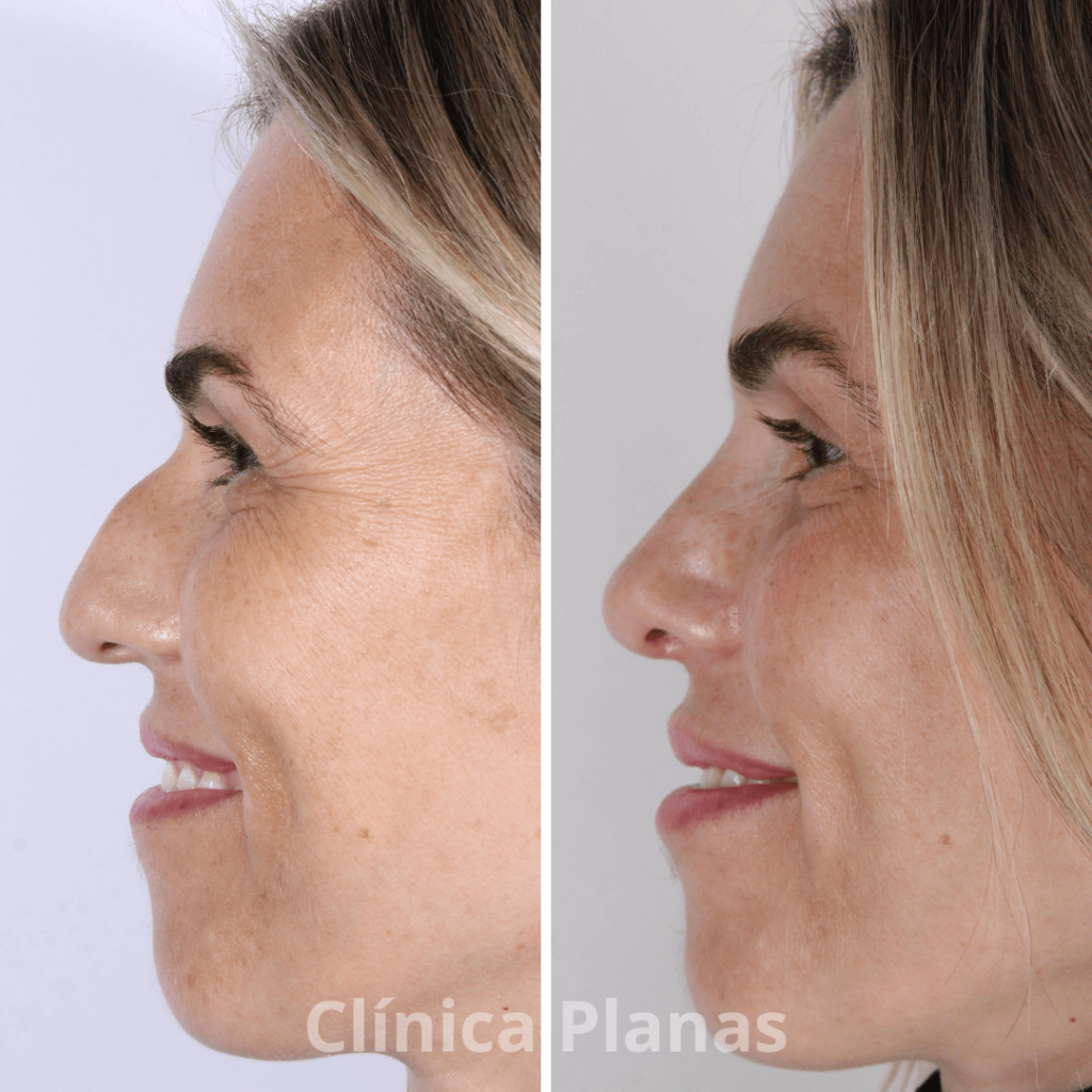 Nariz aguileña: cómo es, procedimientos y recuperación - Tu blog de ...