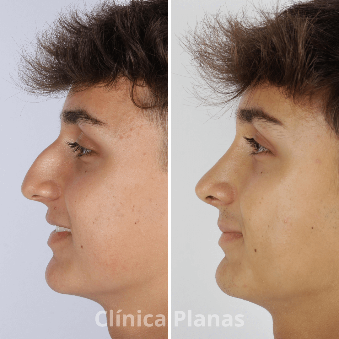 Nariz aguileña cómo es, procedimientos y recuperación Tu blog de