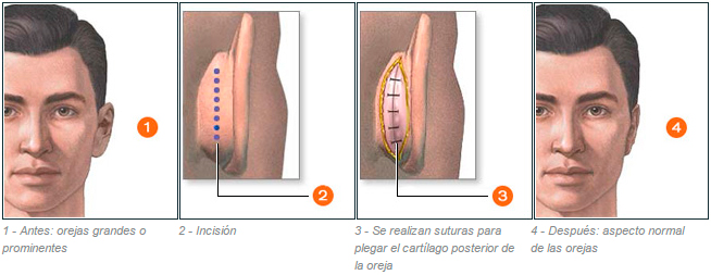 cirugía otoplastia