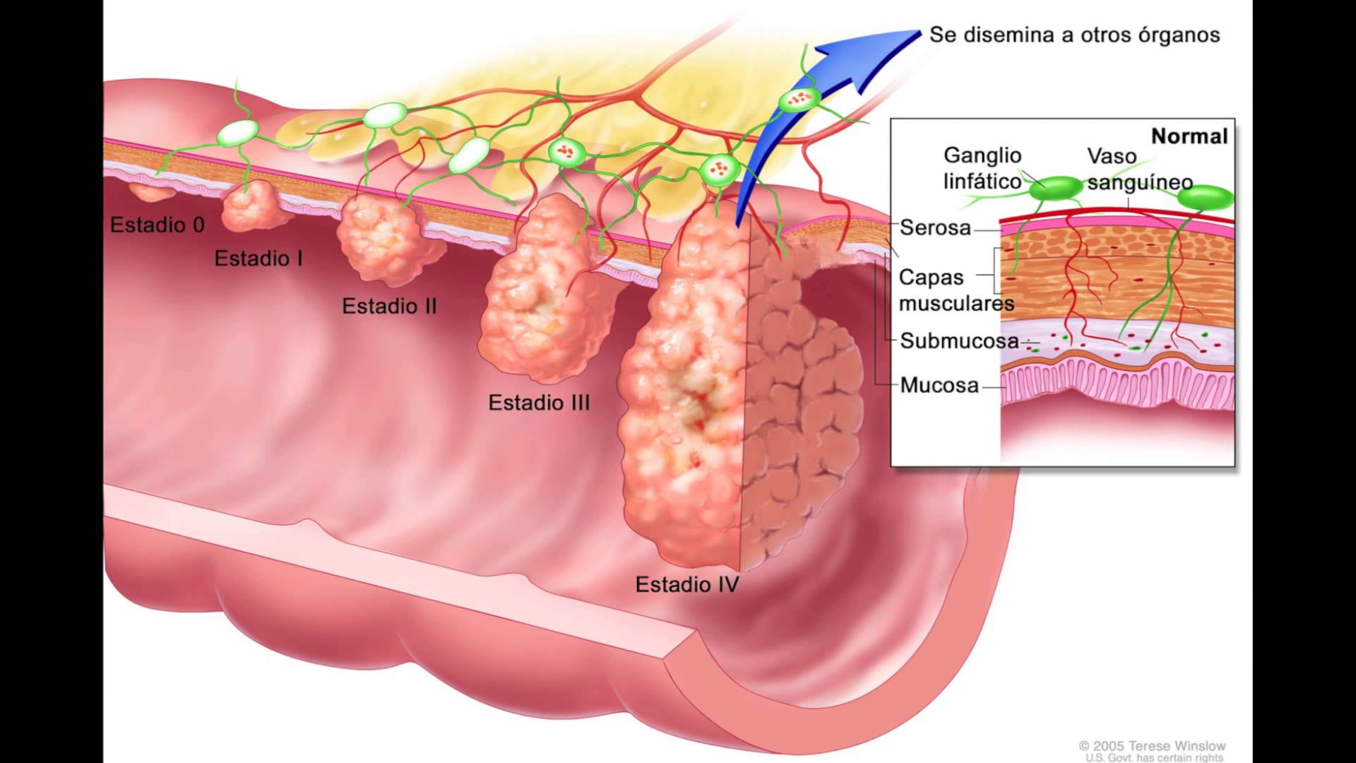 cáncer de colon y su desarrollo