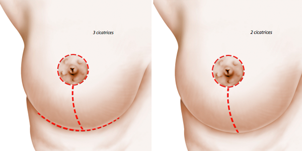 operacion reducción de senos