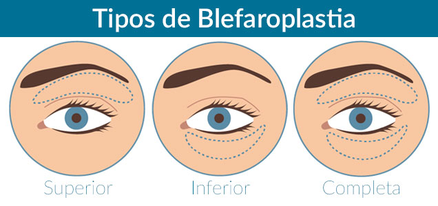 Tipos de blefaroplastia