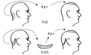 Tecnica FUE y FUSS alopecia