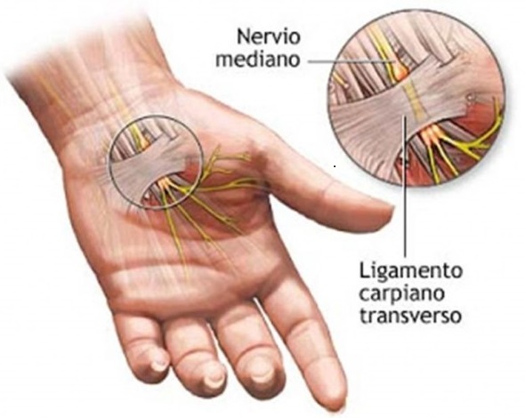 Cirugía Endoscópica Del Túnel Carpiano Clínica Planas Blog