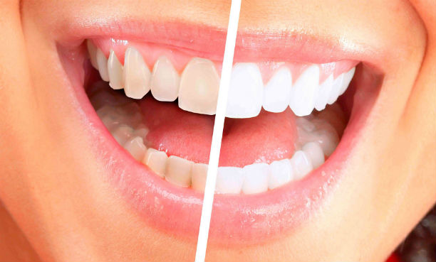 Sonrisa perfecta – Unidad de Estética Dental