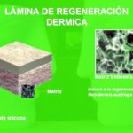 Utilización de regenerador dérmico en Rinoplastia