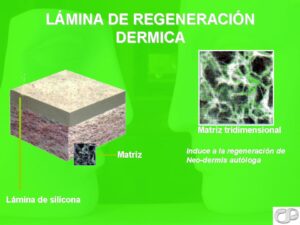 Lamina de Regeneracion Dermica