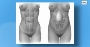 abdominoplastia