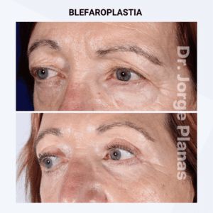 blefaroplastia superior