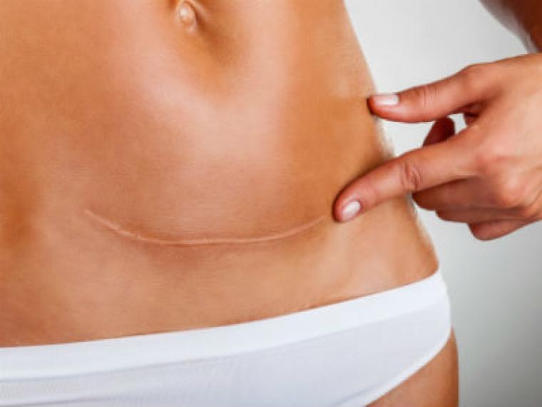Cómo se puede corregir una cicatriz de cesárea - Blog Dr. Planas