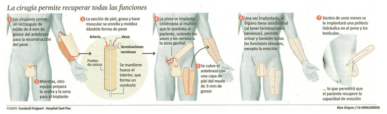 faloplastia.jpg