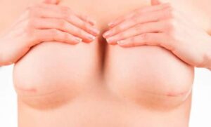 Tecnicas para la reconstruccion mamaria