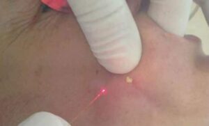 Eliminar rellenos faciales con laser