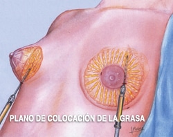 senos tubulares antes y despues de adelgazar senos tubulares antes y despues de adelgazar