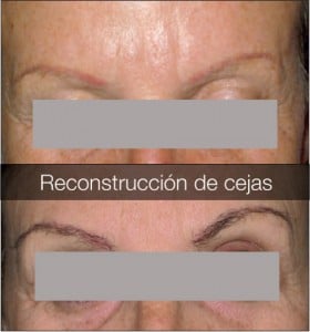 reconstrucción total y parcial de cejas