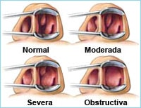 Rinoplastia para respirar mejor, no sólo cambios estéticos