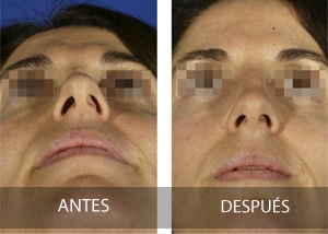 Rinoplastia para respirar mejor, no sólo cambios estéticos