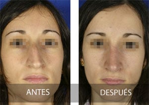 Rinoplastia para respirar mejor, no sólo cambios estéticos