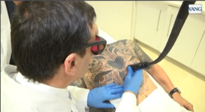 cómo eliminar tatuajes con láser