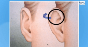 cómo corregir las orejas de soplillo
