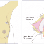 tratamiento preventivo de la contractura capsular