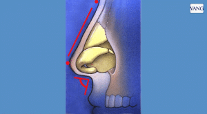 rinoplastia | cómo alargar una nariz corta