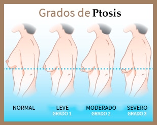 aumento y levantamiento mamario Grados de Ptosis