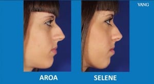 rinoplastia para gemelas