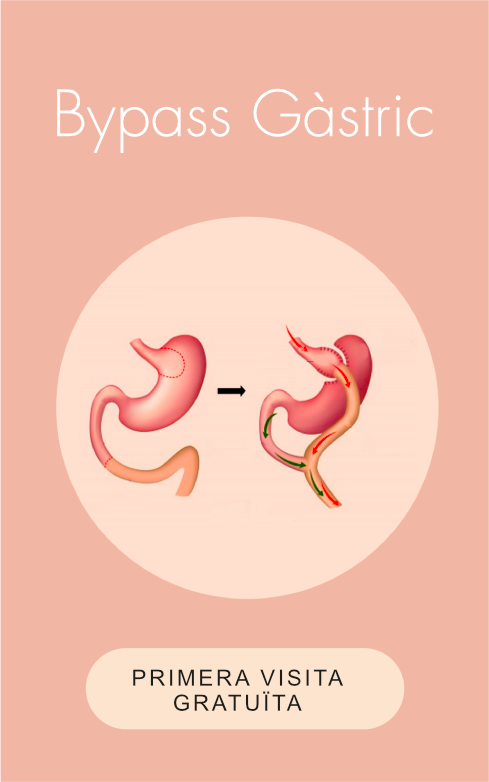 Obesidad - ByPass Gástrico