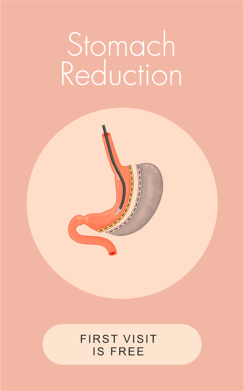 Obesidad - Reducción de estomago